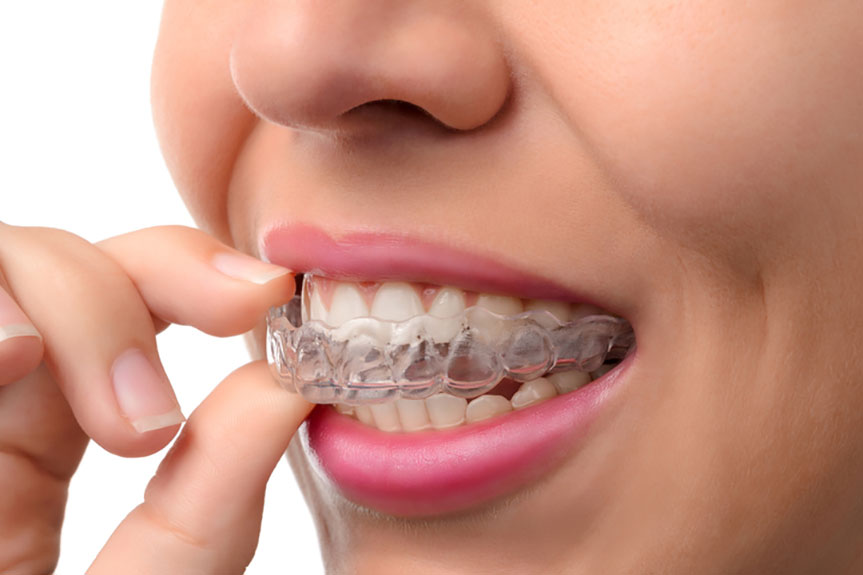 pros-and-cons-of-invisalign